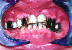 Лазерная стоматология - Низко прикреплённая массивная уздечка верхней губы 