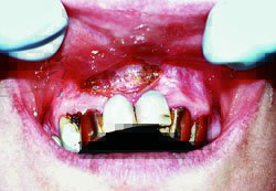 Лазерная стоматология - Состояние после лазерной френулектомии