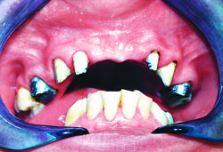 Лазерная стоматология - Мягкие ткани перед фиксацией ортопедических конструкций