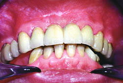 Лазерная стоматология - Заключительный этап ортопедического лечения спустя 10 дней после френулектомии