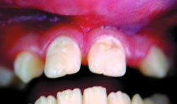 Лазерная стоматология - Кариес вестибулярной поверхности 11 и 21 зубов и дистальной поверхности 11 зуба у ребенка 12 лет
