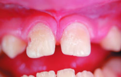 Лазерная стоматология - Вид отпрепарированных лазером поверхностей
