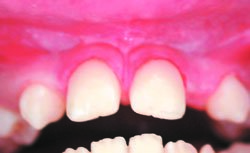 Лазерная стоматология - Завершенная реставрация