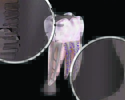 Лазерная стоматология - Отсутствие микрофлоры по окончании процедуры