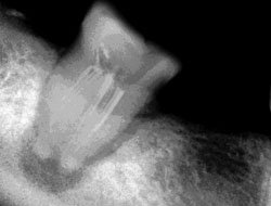 Лазерная стоматология - Рентгеновский снимок 47-го зуба. Хронический гранулематозный периодонтит