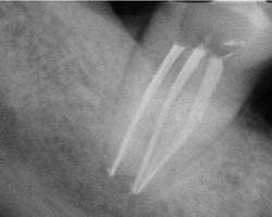 Лазерная стоматология - Рентгеновский снимок 47-го зуба через 6 месяцев после ФАД